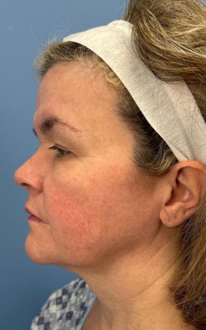 Facelift and Necklift Before & After Patient #16863