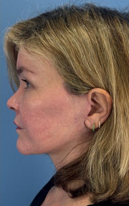 Facelift and Necklift Before & After Patient #16863