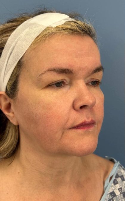 Facelift and Necklift Before & After Patient #16863