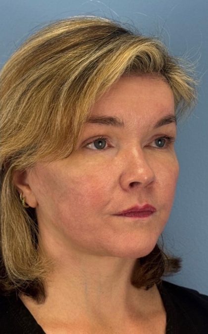 Facelift and Necklift Before & After Patient #16863