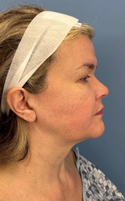 Facelift and Necklift Before & After Patient #16863