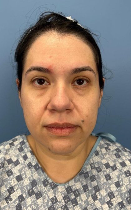Facelift and Necklift Before & After Patient #16852