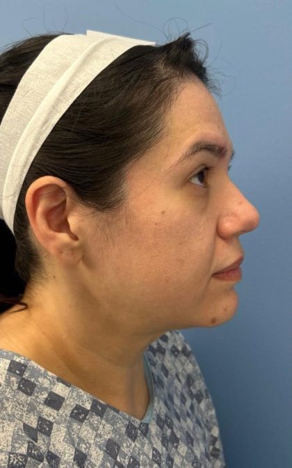 Facelift and Necklift Before & After Patient #16852