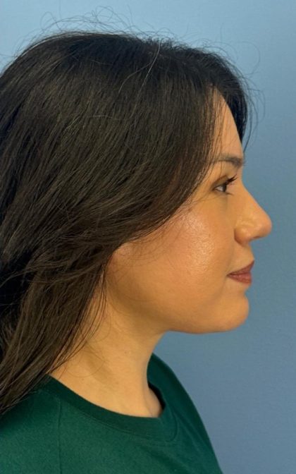 Facelift and Necklift Before & After Patient #16852