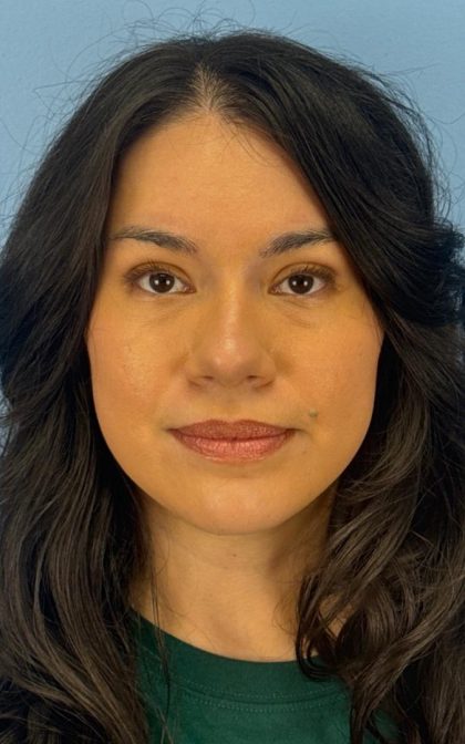 Facelift and Necklift Before & After Patient #16852