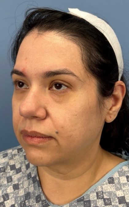 Facelift and Necklift Before & After Patient #16852