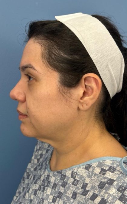 Facelift and Necklift Before & After Patient #16852