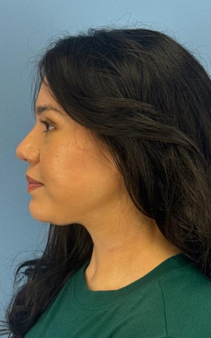 Facelift and Necklift Before & After Patient #16852