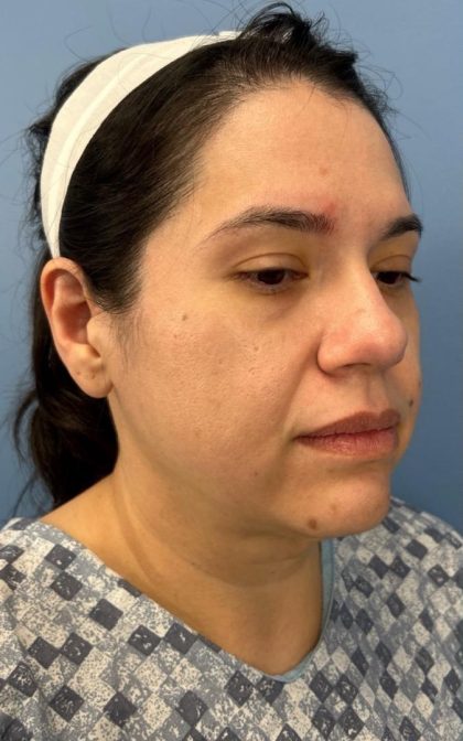 Facelift and Necklift Before & After Patient #16852