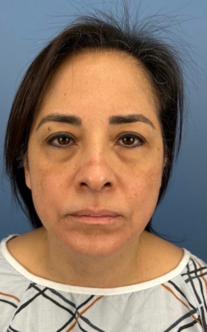 Blepharoplasty Before & After Patient #17093