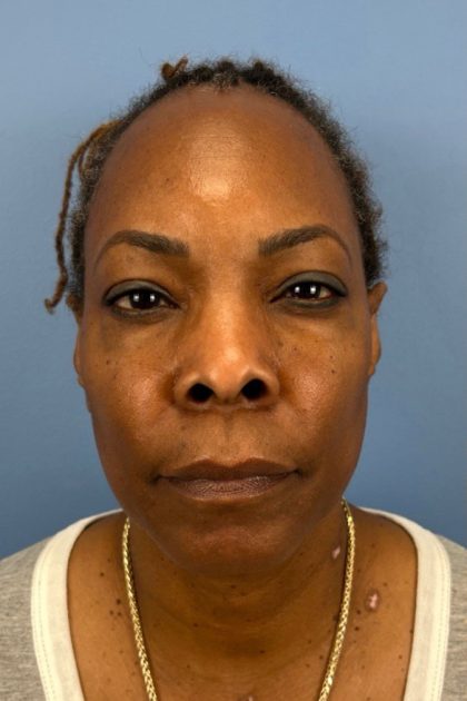 Blepharoplasty Before & After Patient #17029