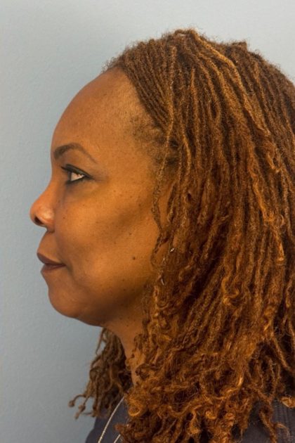 Blepharoplasty Before & After Patient #17029
