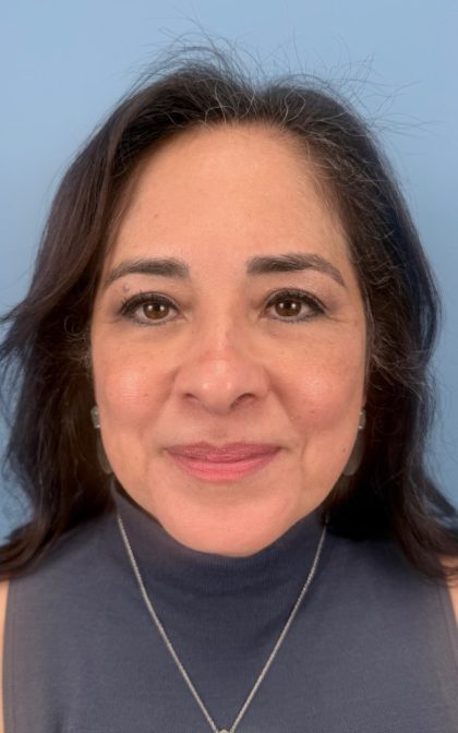 Blepharoplasty Before & After Patient #17093