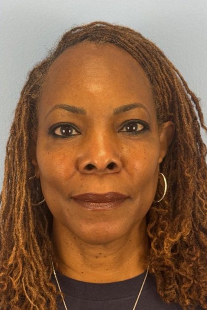 Blepharoplasty Before & After Patient #17029