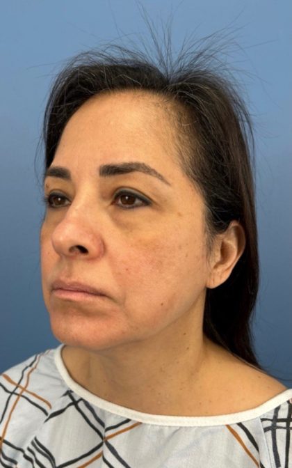 Blepharoplasty Before & After Patient #17093
