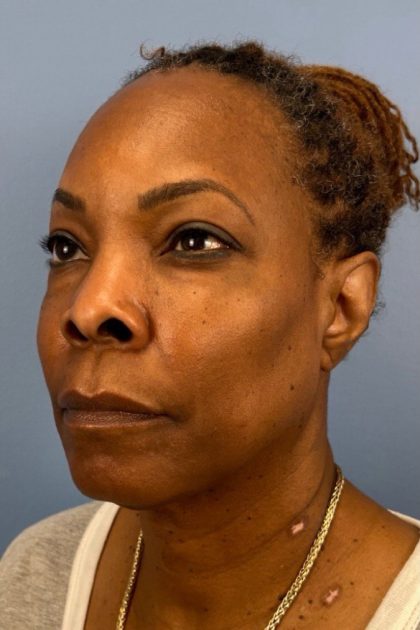Blepharoplasty Before & After Patient #17029
