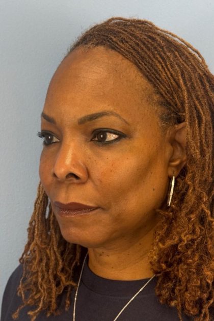 Blepharoplasty Before & After Patient #17029