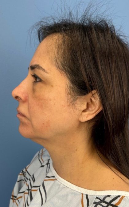 Blepharoplasty Before & After Patient #17093