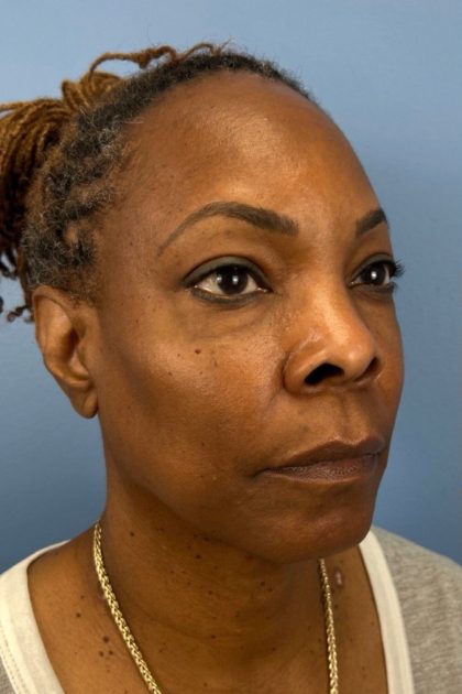 Blepharoplasty Before & After Patient #17029