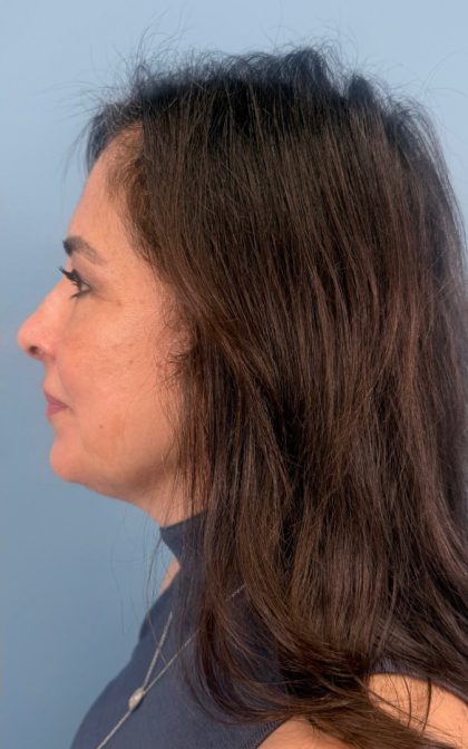 Blepharoplasty Before & After Patient #17093