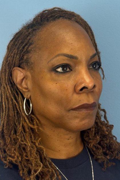 Blepharoplasty Before & After Patient #17029