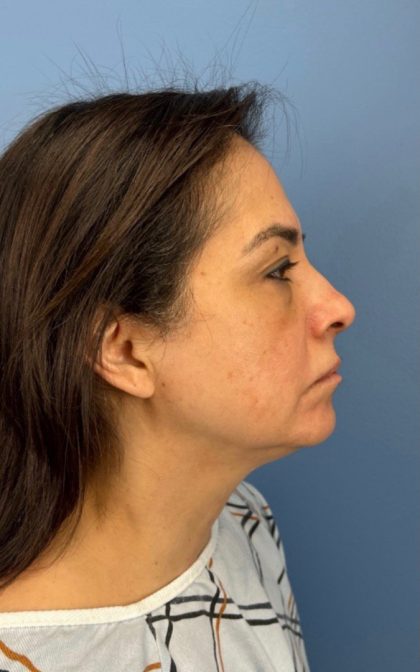 Blepharoplasty Before & After Patient #17093
