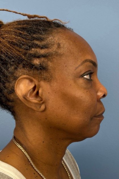 Blepharoplasty Before & After Patient #17029