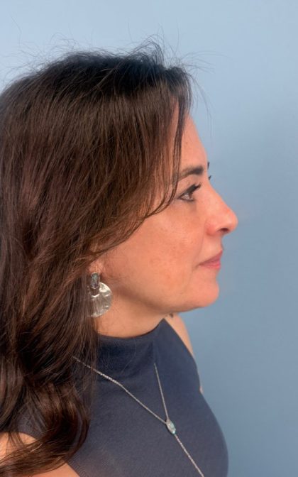 Blepharoplasty Before & After Patient #17093