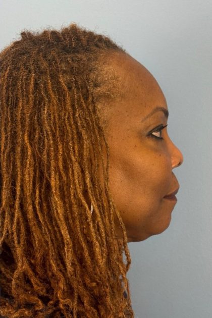 Blepharoplasty Before & After Patient #17029
