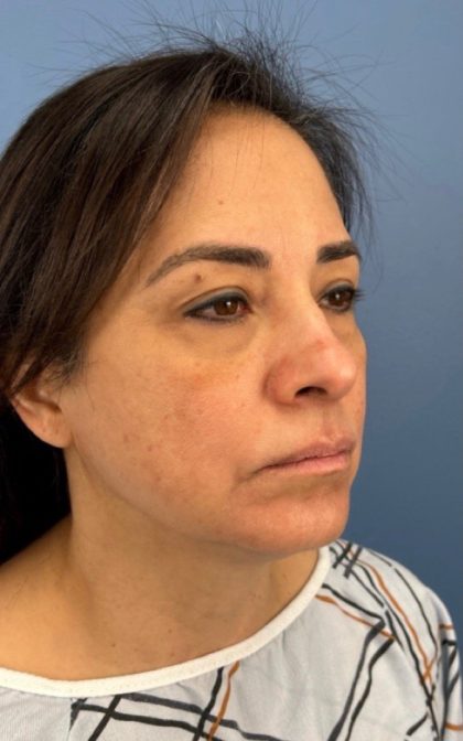 Blepharoplasty Before & After Patient #17093