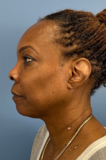 Blepharoplasty Before & After Patient #17029