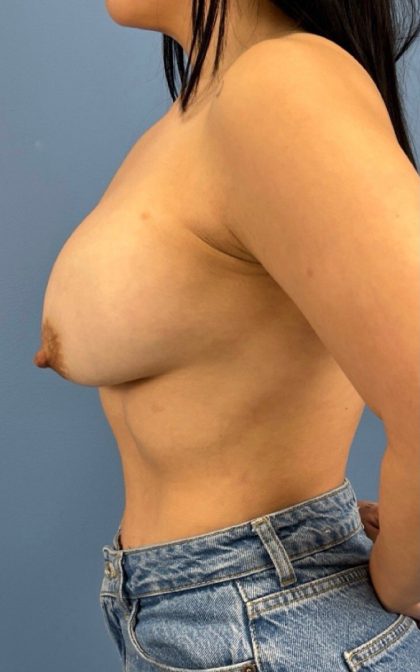 Breast Augmentation Before & After Patient #17072