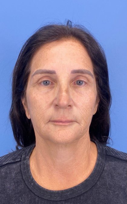 CO2 Laser Before & After Patient #17170