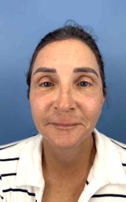 CO2 Laser Before & After Patient #17170