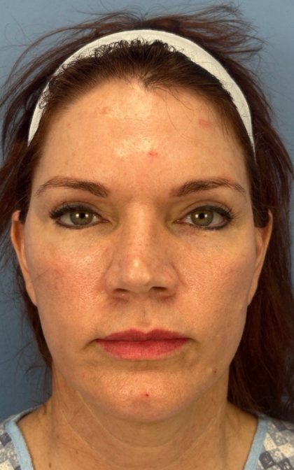 Facelift and Necklift Before & After Patient #17071