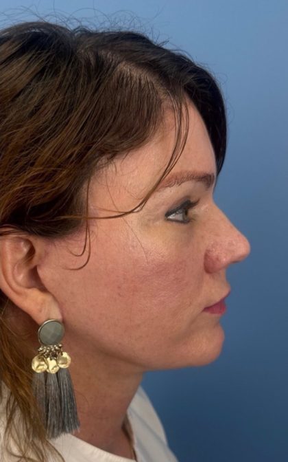 Facelift and Necklift Before & After Patient #17071