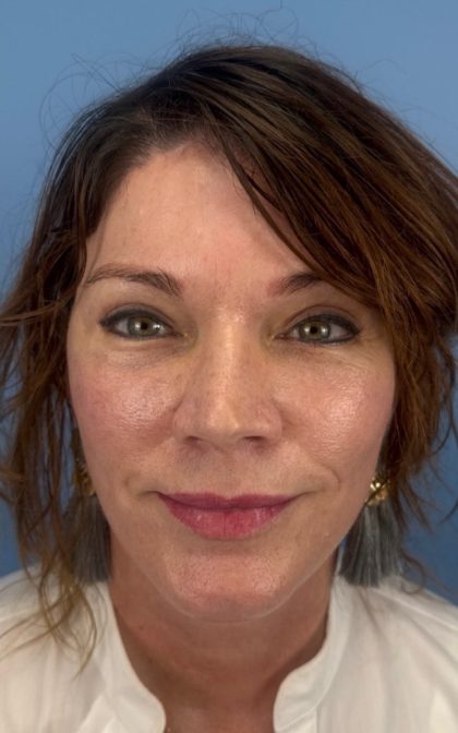 Facelift and Necklift Before & After Patient #17071