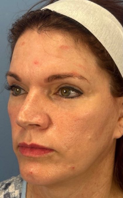 Facelift and Necklift Before & After Patient #17071