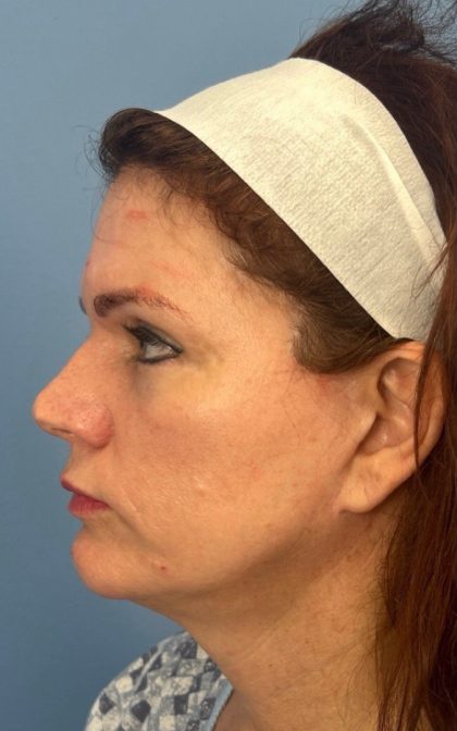 Facelift and Necklift Before & After Patient #17071