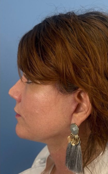 Facelift and Necklift Before & After Patient #17071