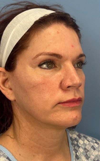 Facelift and Necklift Before & After Patient #17071