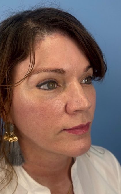Facelift and Necklift Before & After Patient #17071