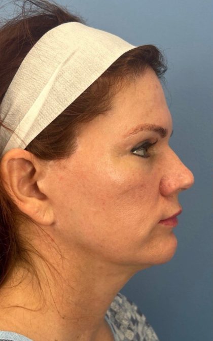 Facelift and Necklift Before & After Patient #17071